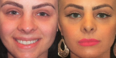 Rhinoplasty before and after photo