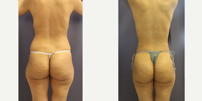 Brazilian Butt Lift before and after photo