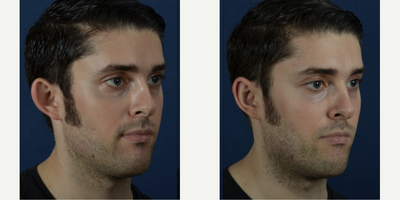 Ear Surgery before and after photo
