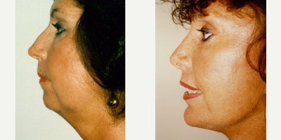 Facelift before and after photo