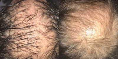 PRP Injections before and after photo