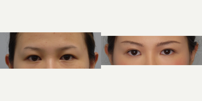 Eyelid Surgery before and after photo