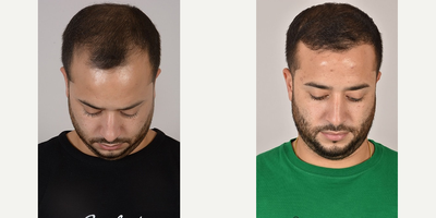 Hair Transplant before and after photo