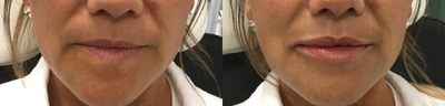 Juvederm before and after photo