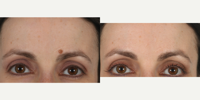 Mole Removal before and after photo