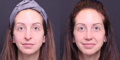 Rhinoplasty before and after photo