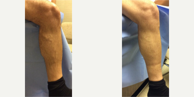 Sclerotherapy before and after photo