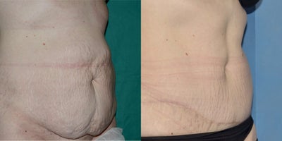 Tummy Tuck before and after photo