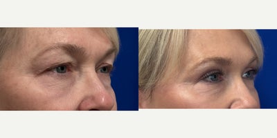 Eyelid Surgery before and after photo