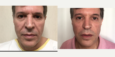 Facelift before and after photo