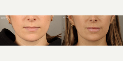 Lip Fillers before and after photo