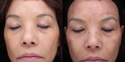 Microneedling before and after photo