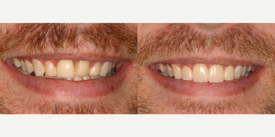 Porcelain Veneers before and after photo