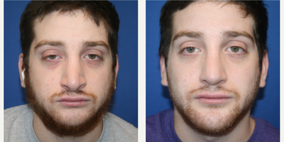Revision Rhinoplasty before and after photo