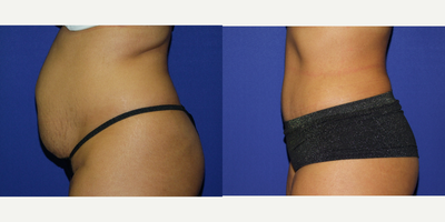 Tummy Tuck before and after photo