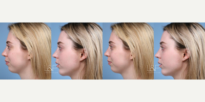 Buccal Fat Removal before and after photo