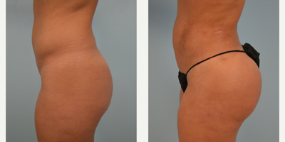 Butt Augmentation before and after photo