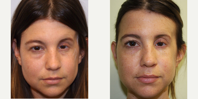 Dermal Fillers before and after photo