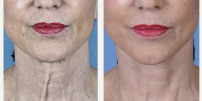 Facelift before and after photo