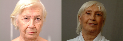 Facelift before and after photo