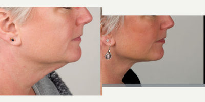 Neck Lift before and after photo