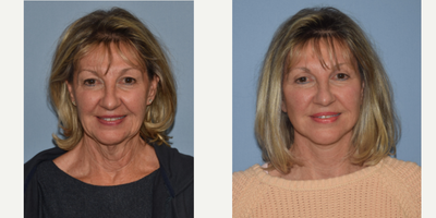 Facelift before and after photo
