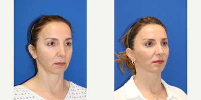 Deep Plane Facelift before and after photo