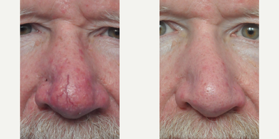 Dermabrasion before and after photo