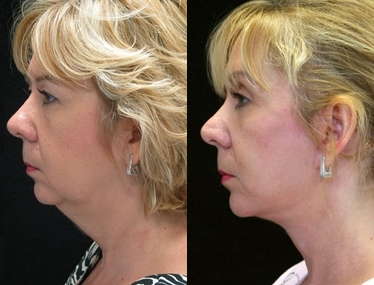 Facelift before and after photo
