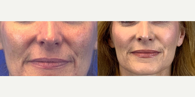 Restylane before and after photo