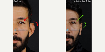 Botox before and after photo