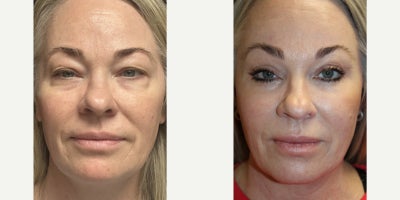 Brow Lift before and after photo