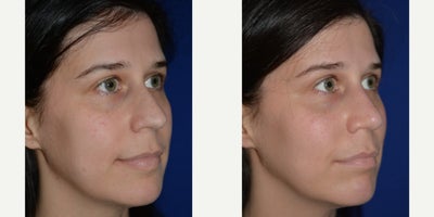 Rhinoplasty before and after photo