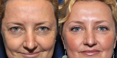 Eyelid Surgery before and after photo