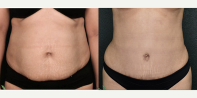 Tummy Tuck before and after photo