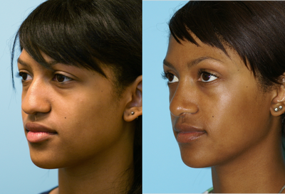 African American Rhinoplasty before and after photo