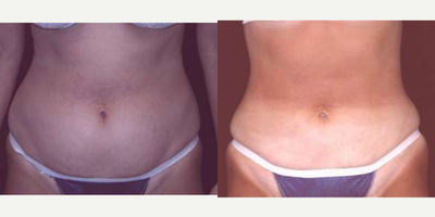 Liposuction before and after photo