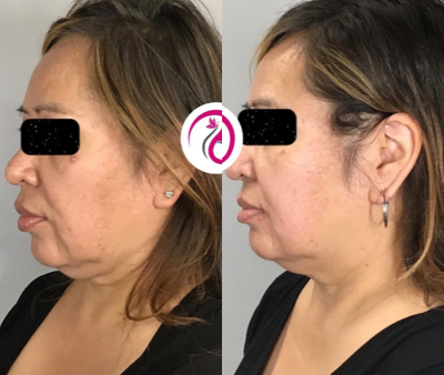 Profound RF before and after photo