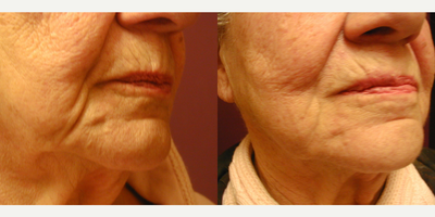 ProFractional Laser before and after photo