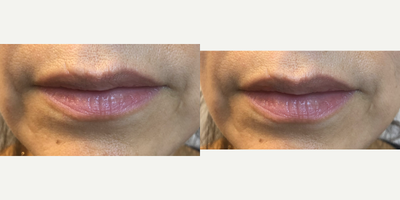 Lip Fillers before and after photo