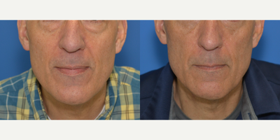 Lower Facelift before and after photo