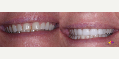 Porcelain Veneers before and after photo
