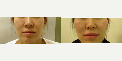 PRP Injections before and after photo