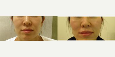 PRP Injections before and after photo
