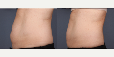CoolSculpting before and after photo