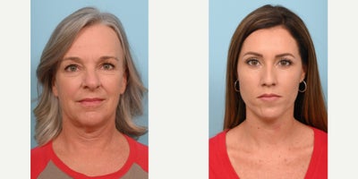 Eyelid Surgery before and after photo
