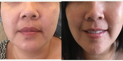 Nonsurgical Facelift before and after photo