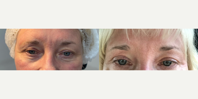 Plasma Fibroblasting before and after photo