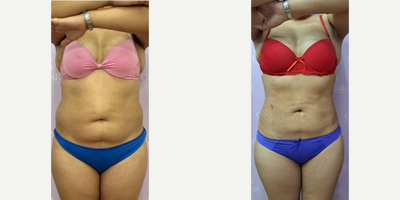 Tumescent Liposuction before and after photo