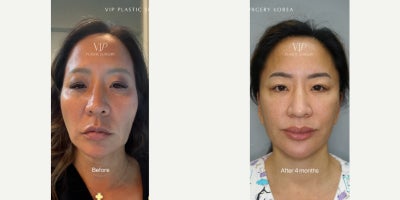 Facial Fat Transfer before and after photo